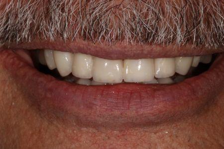 image of Full Mouth 1a