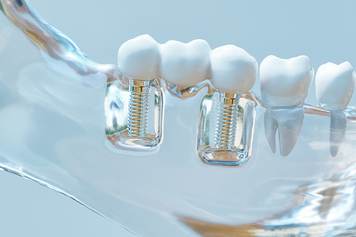 Model of dental implants in glass jaw