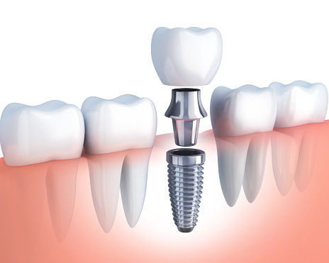 Single tooth implant in row of teeth Single tooth implant in row of teeth