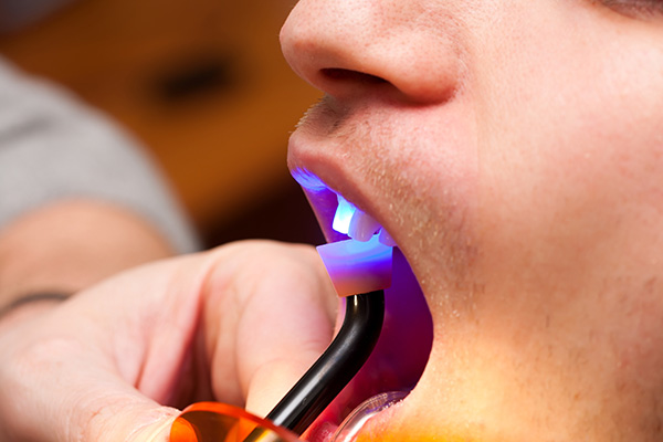 Dentist working with dental bonding tool in oral cavity.