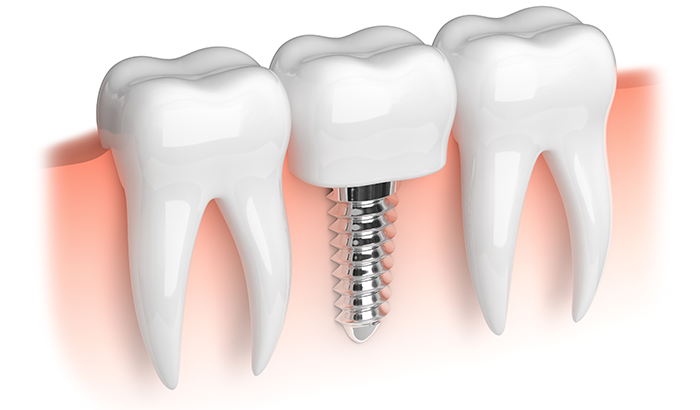 Diagram image of a dental implant at Enamel General and Cosmetic Dentistry in Newport Beach, CA.